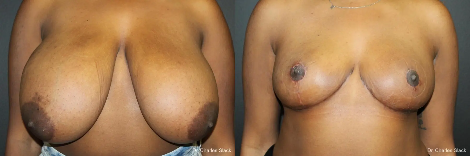 Breast Reduction: Patient 3 - Before and After  