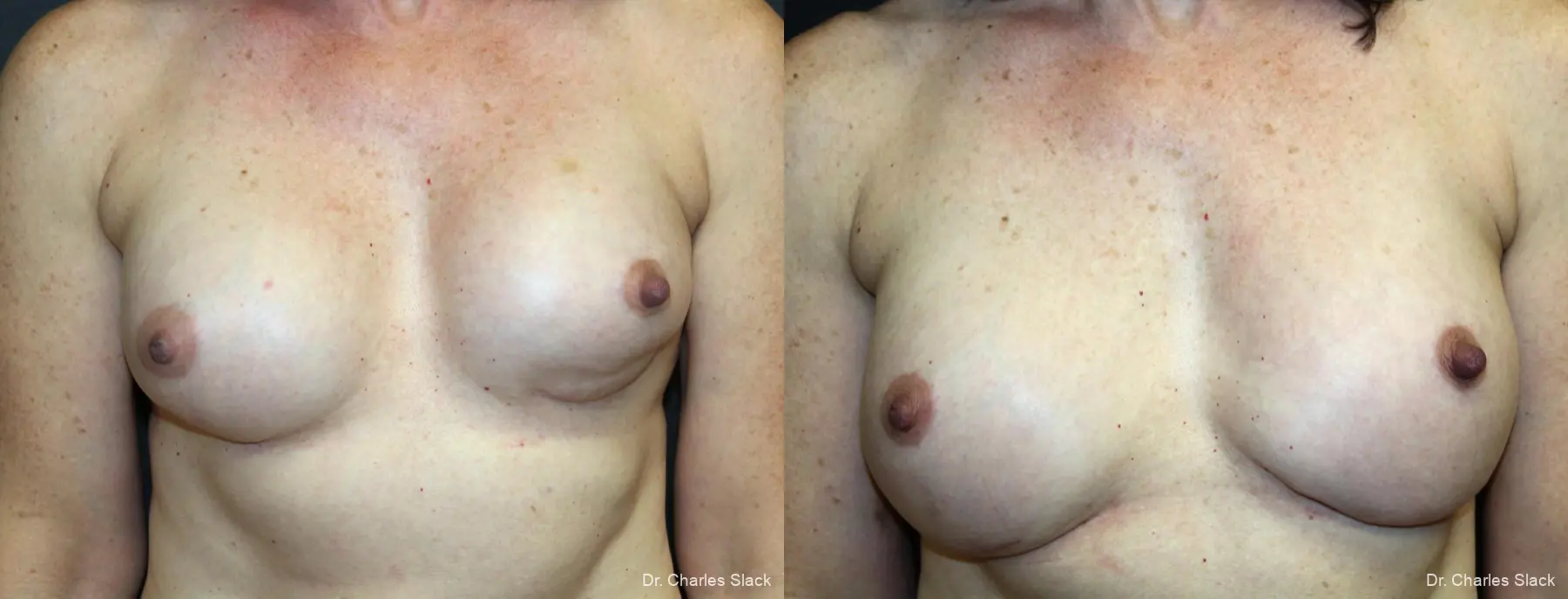 Breast Revision: Patient 1 - Before and After  