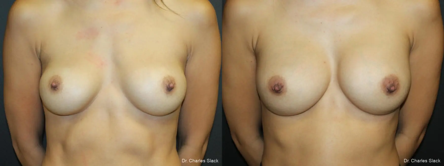 Breast Revision: Patient 10 - Before and After  