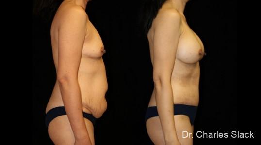 Mommy Makeover: Patient 2 - Before and After  