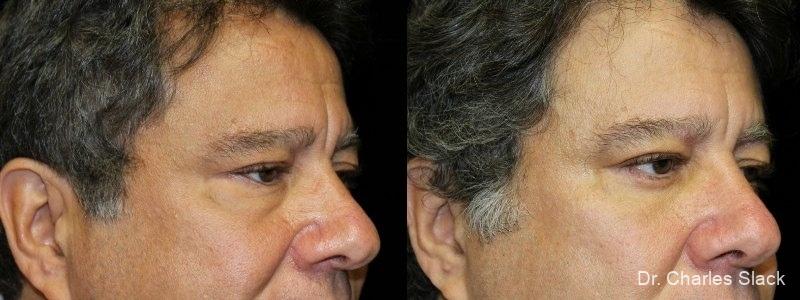 Blepharoplasty: Patient 1 - Before and After  