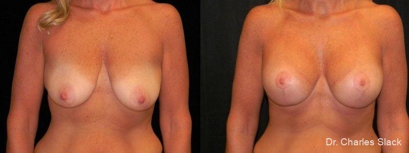 Breast Augmentation With Lift: Patient 4 - Before and After  