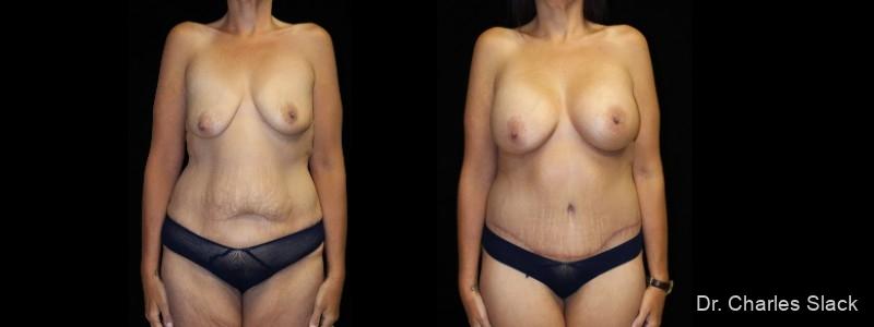 Mommy Makeover: Patient 6 - Before and After  
