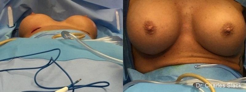Breast Revision: Patient 4 - Before and After  