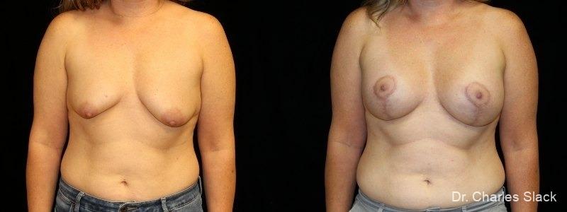 Breast Augmentation With Lift: Patient 5 - Before and After  