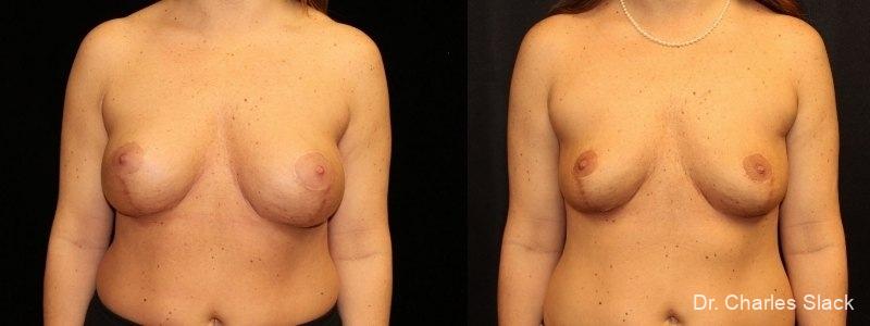 Breast Revision: Patient 8 - Before and After  