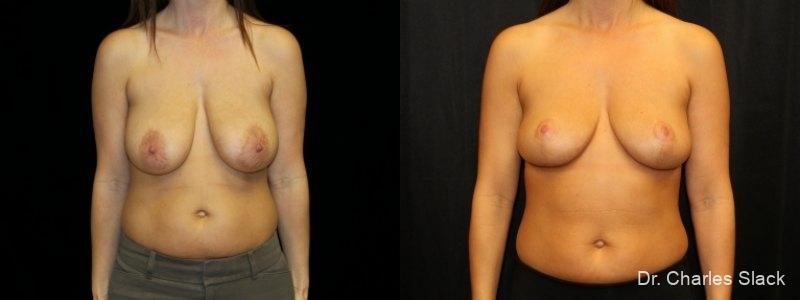 Breast Lift: Patient 5 - Before and After  