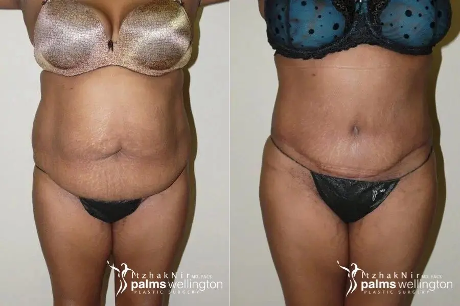 Tummy Tuck | Riviera Beach - Before and After