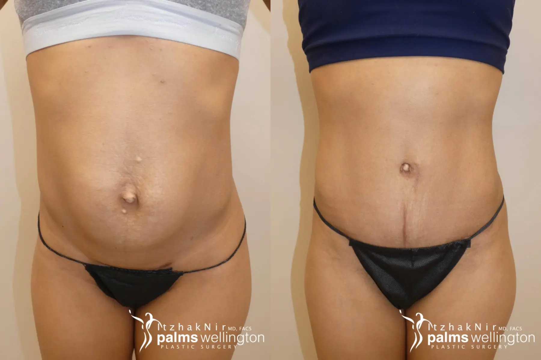 Tummy Tuck | Wellington - Before and After