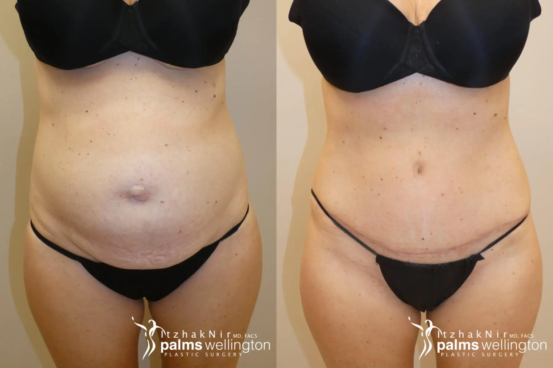 Tummy Tuck | Palm Beach Gardens - Before and After
