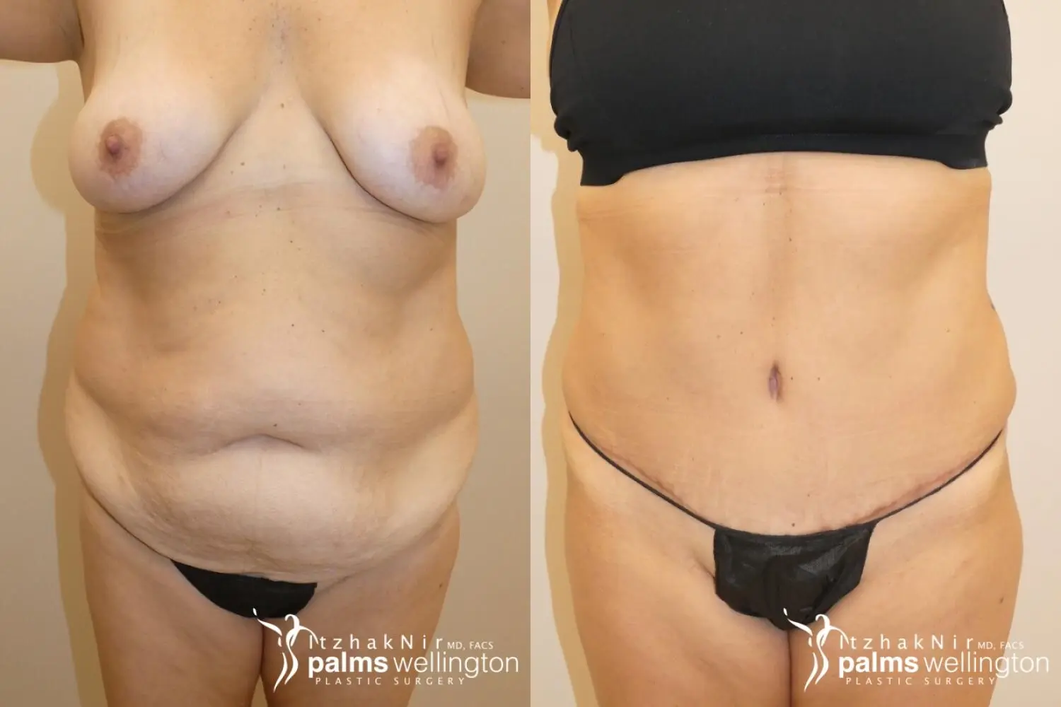 Tummy Tuck | Jupiter - Before and After