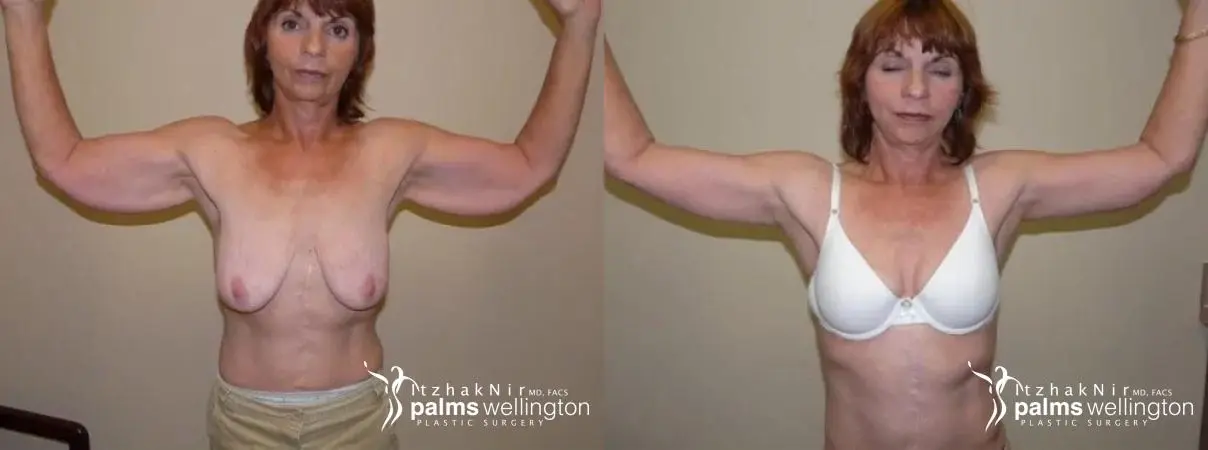 Arm Lift | West Palm Beach - Before and After
