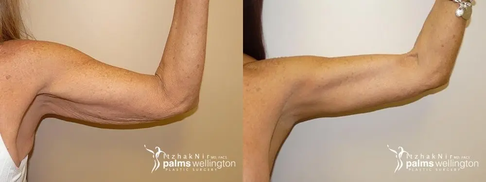 Arm Lift | Boca Raton - Before and After