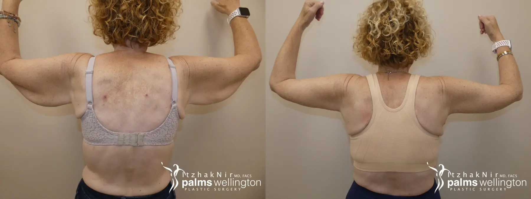 Arm Lift | Boynton Beach - Before and After