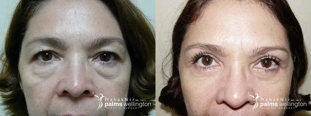 Blepharoplasty | West Palm Beach - Before and After