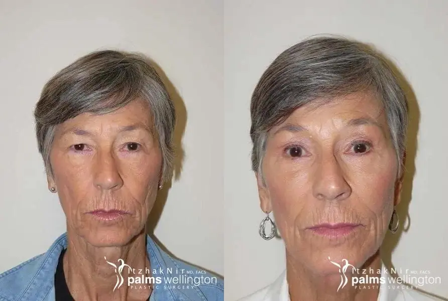 Blepharoplasty | Boynton Beach - Before and After