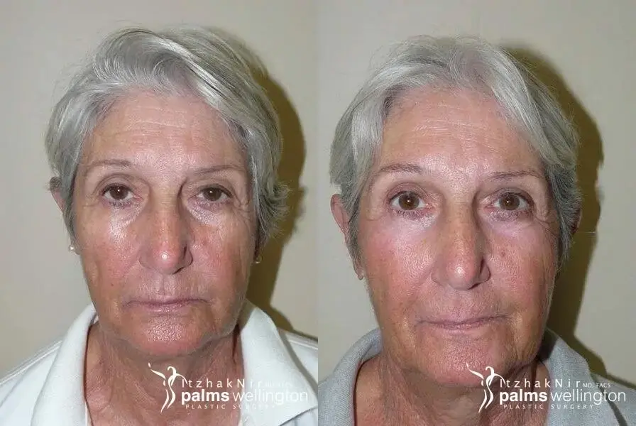 Blepharoplasty | Boca Raton - Before and After