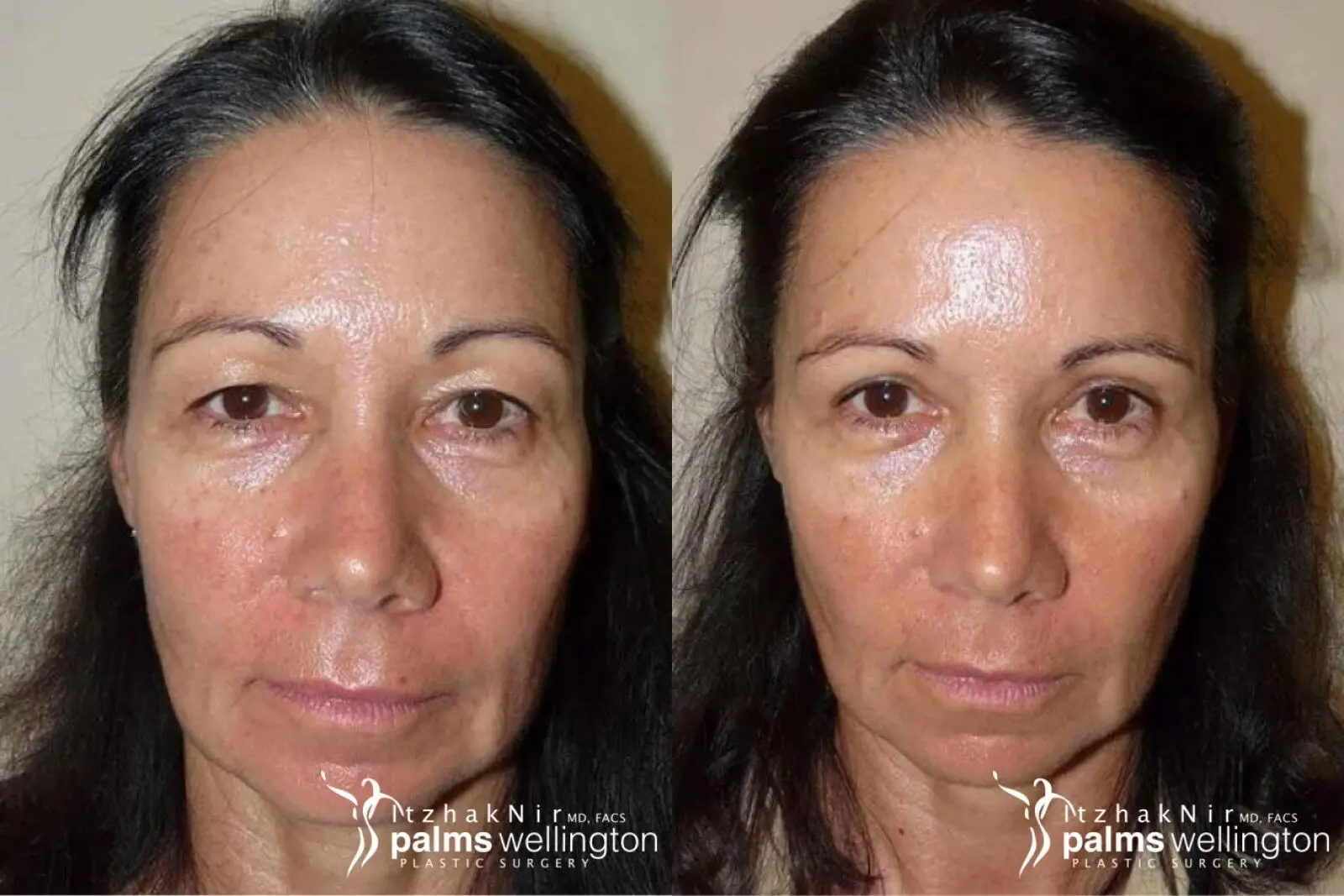 Blepharoplasty | West Palm Beach - Before and After