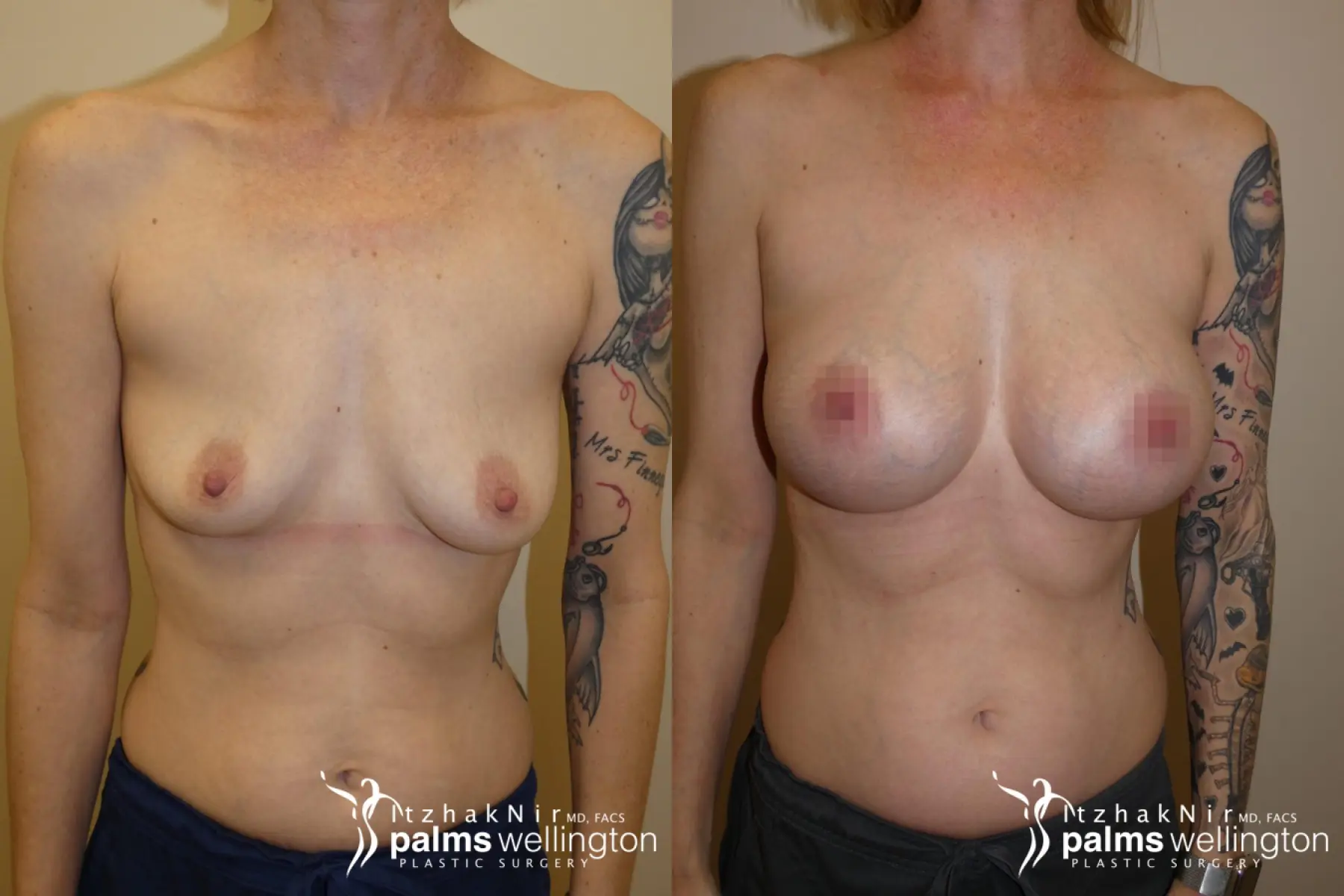 Breast Augmentation West Palm Beach - Before and After