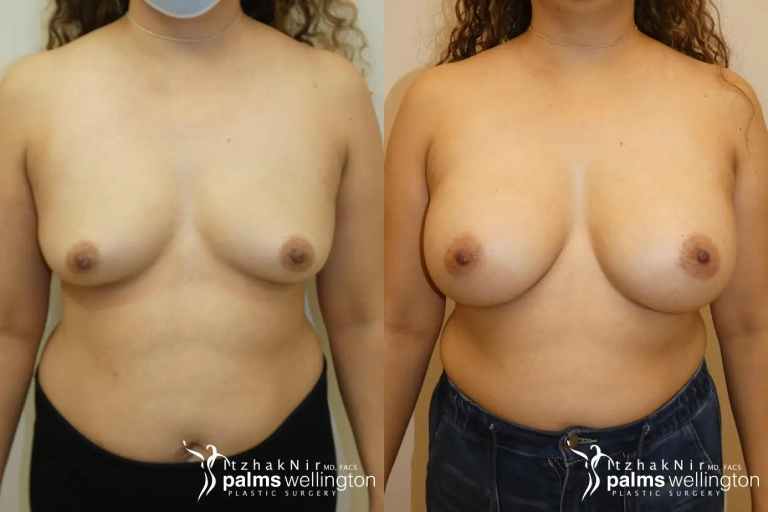 Breast Augmentation Royal Palm Beach - Before and After
