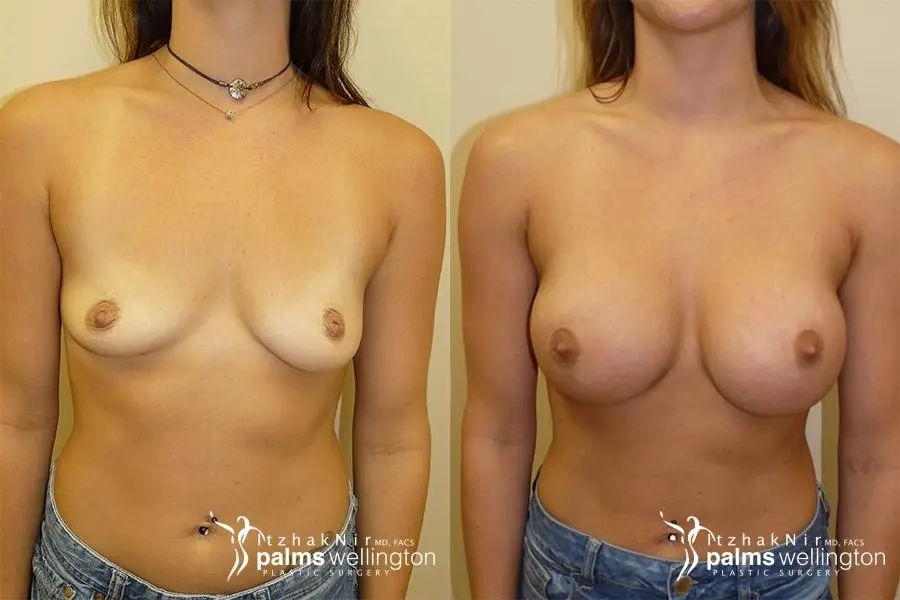 Breast Augmentation | Boca Raton - Before and After