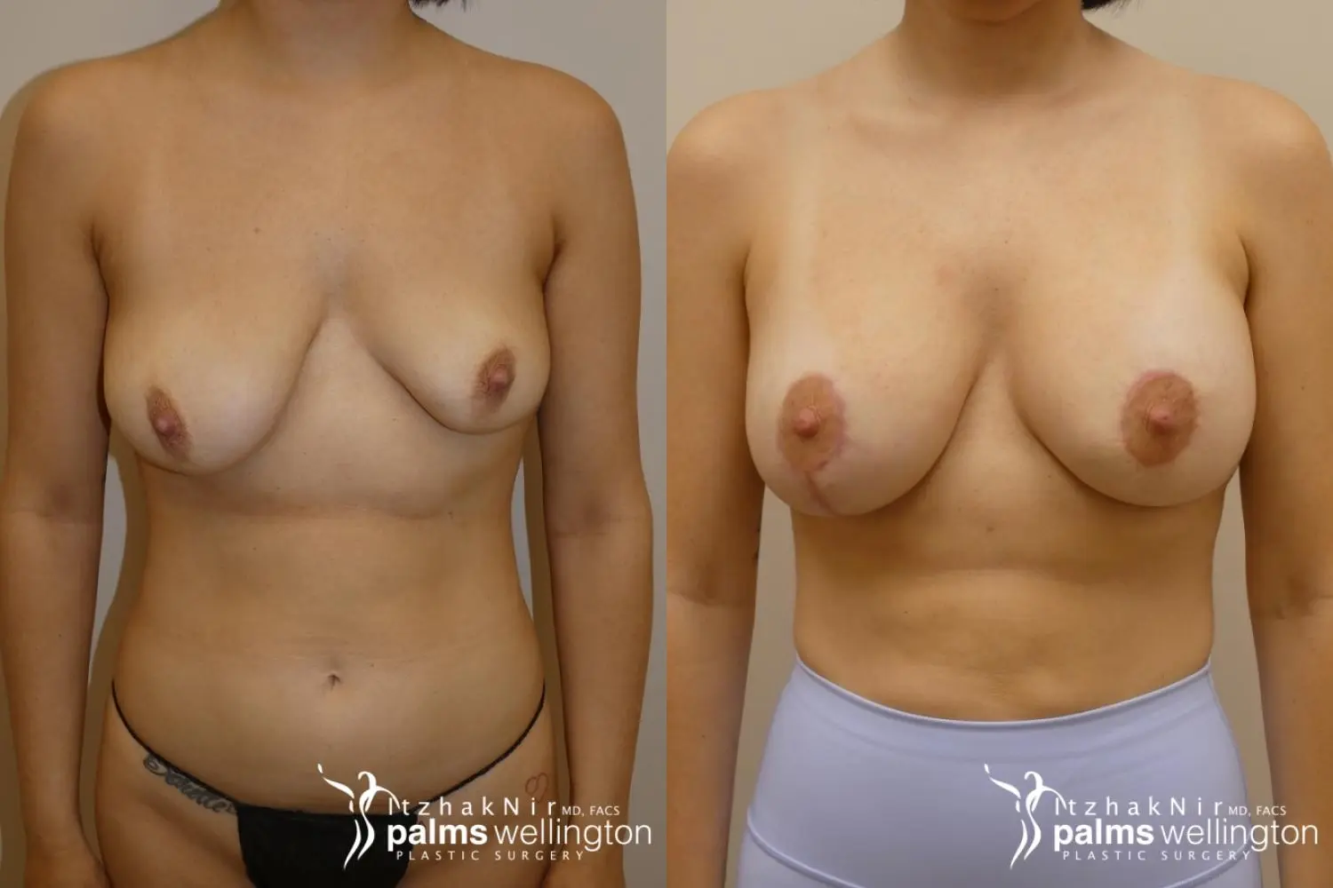 Breast Augmentation Loxahatchee - Before and After