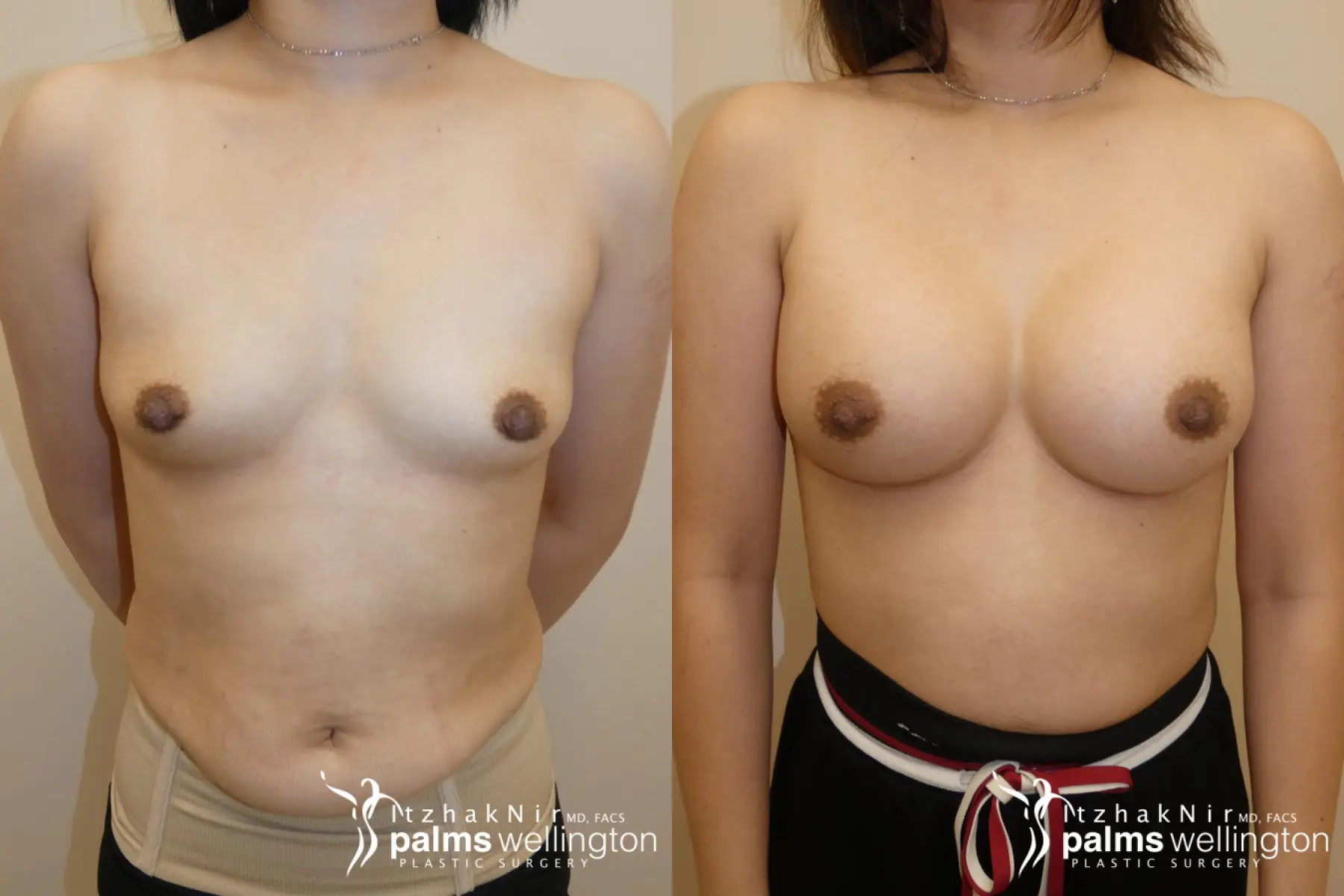 Breast Augmentation | Palm Beach County - Before and After