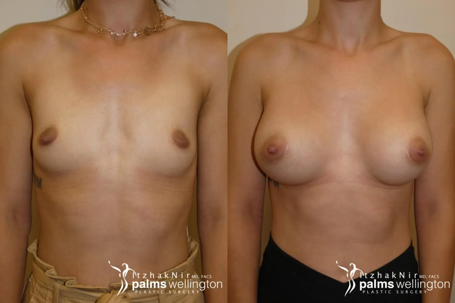 Breast Augmentation Wellington FL - Before and After