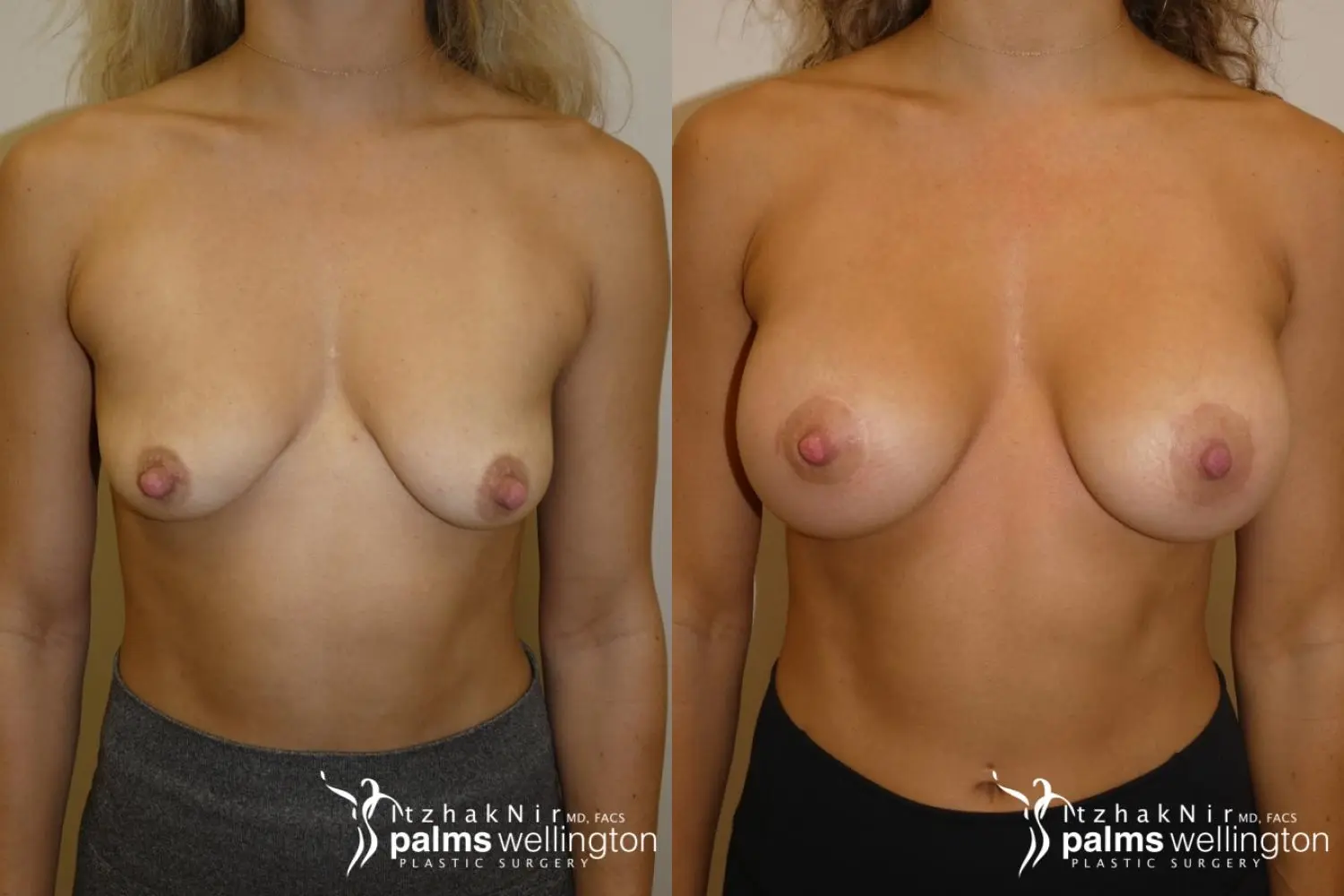 Breast Augmentation with Lift | Greenacres - Before and After