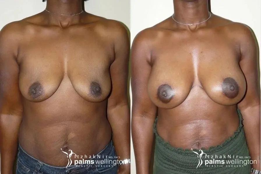 Breast Augmentation With Lift | North Palm Beach - Before and After