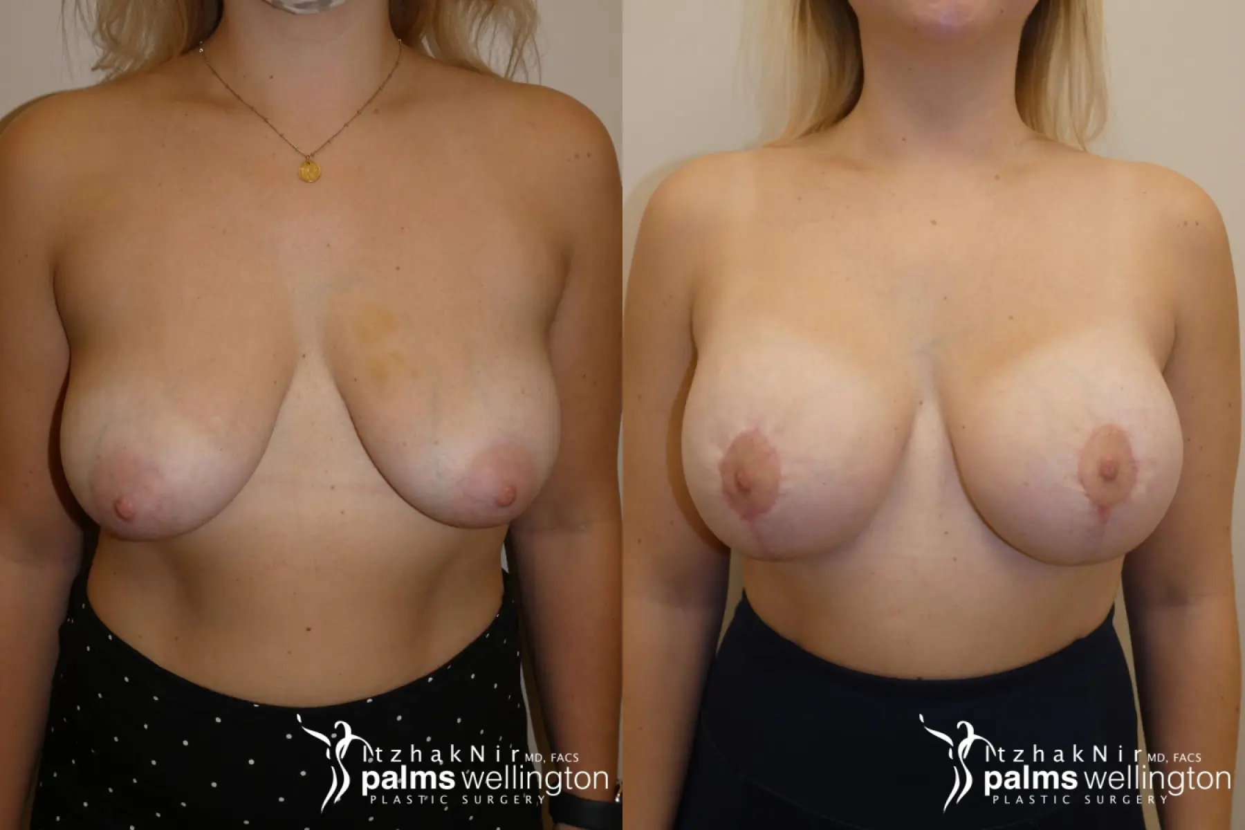 Breast Augmentation with Lift | Boynton Beach - Before and After