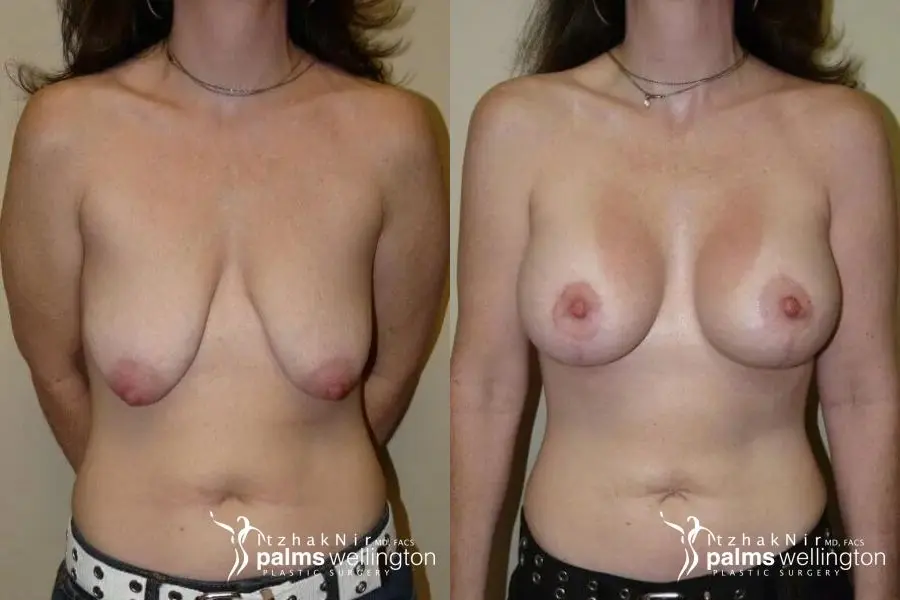 Breast Augmentation With Lift | Palm Beach Gardens - Before and After