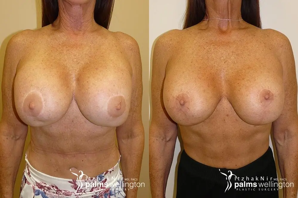 Breast Implant Exchange |  Boynton Beach - Before and After