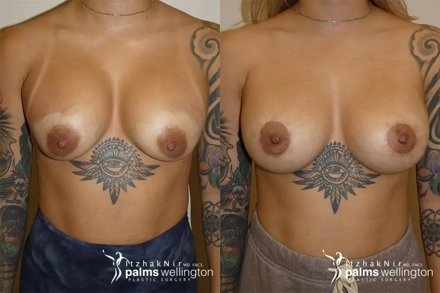 Breast Implant Exchange |  Boca Raton - Before and After
