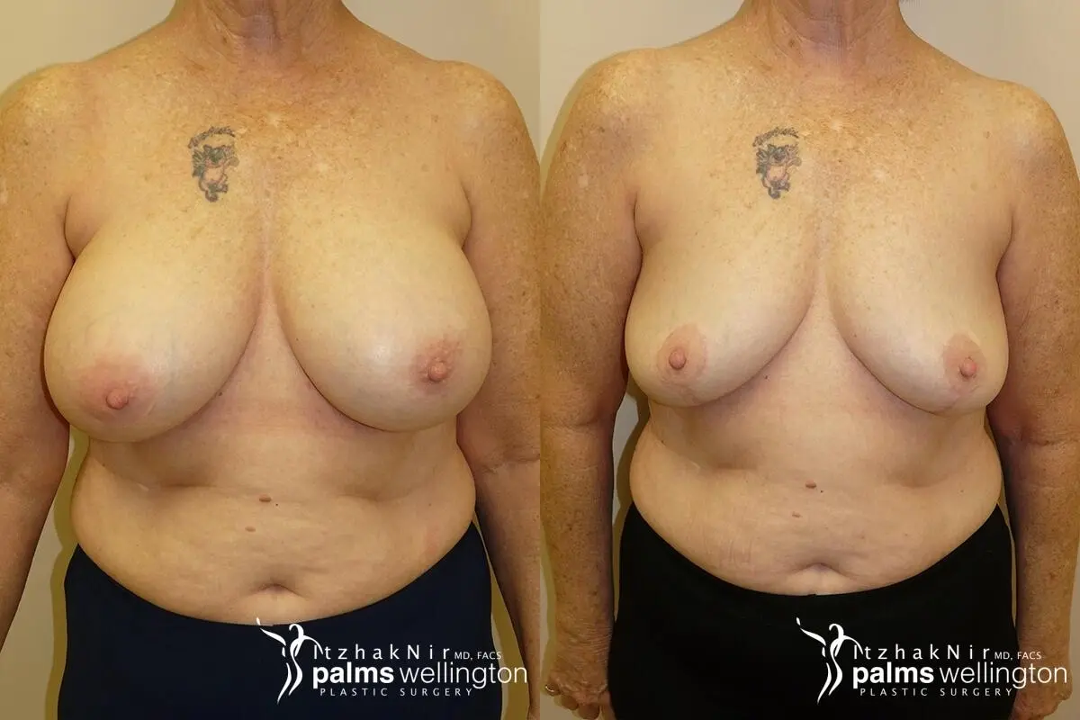 Breast Implant Removal with Lift | Delray Beach - Before and After