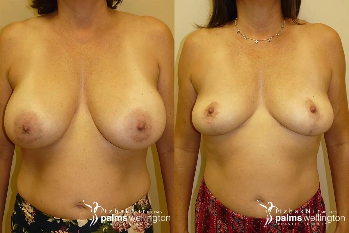 Breast Implant Removal with Lift | Boynton Beach - Before and After