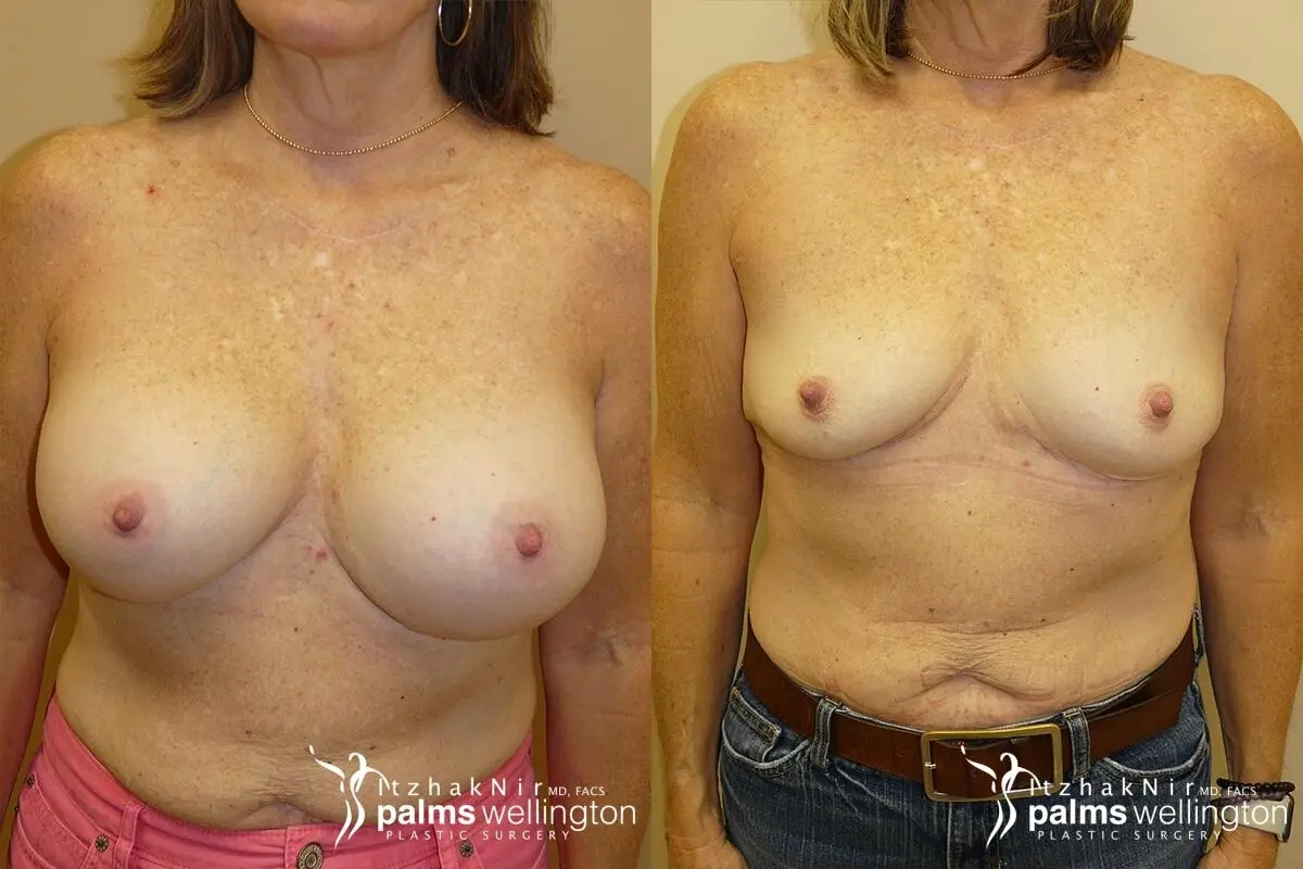Breast Implant Removal with Lift | Boca Raton - Before and After