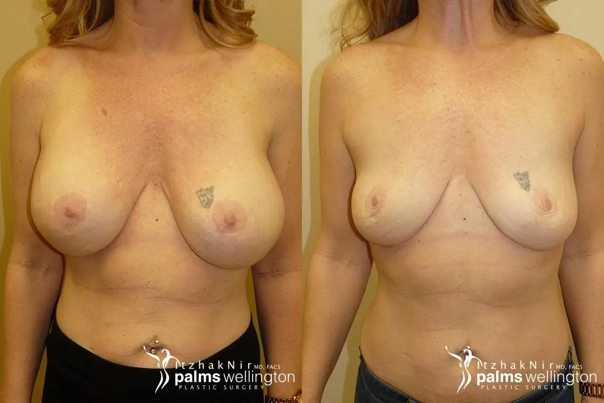 Breast Implant Removal with Lift | West Palm Beach - Before and After