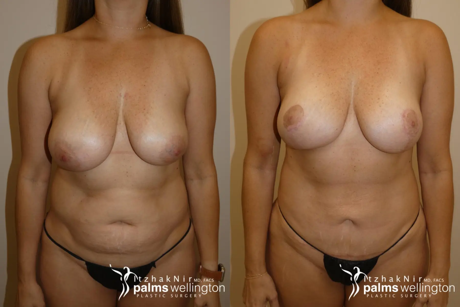 Breast Lift | Boynton Beach - Before and After