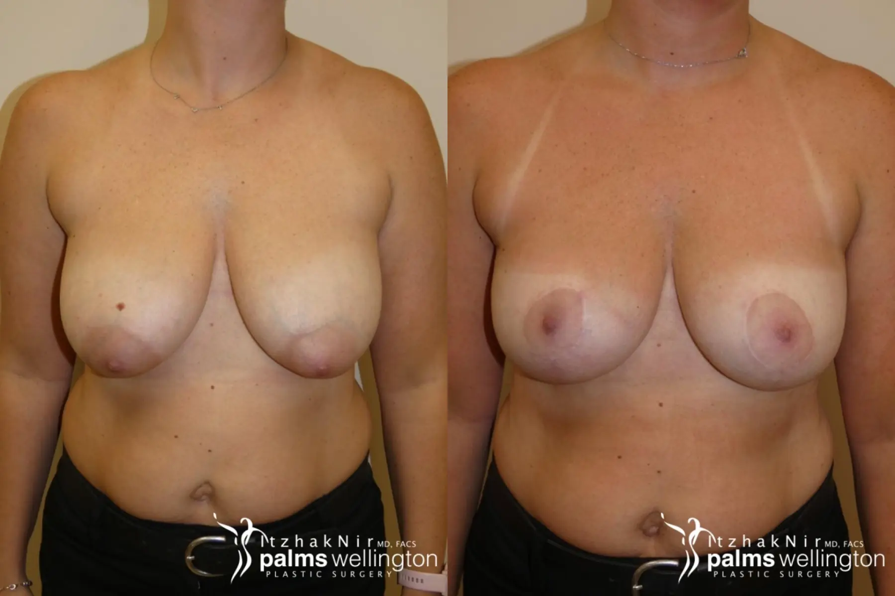 Breast Lift | West Palm Beach - Before and After