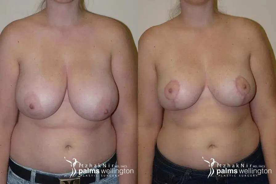 Breast Lift WestPalmBeach - Before and After