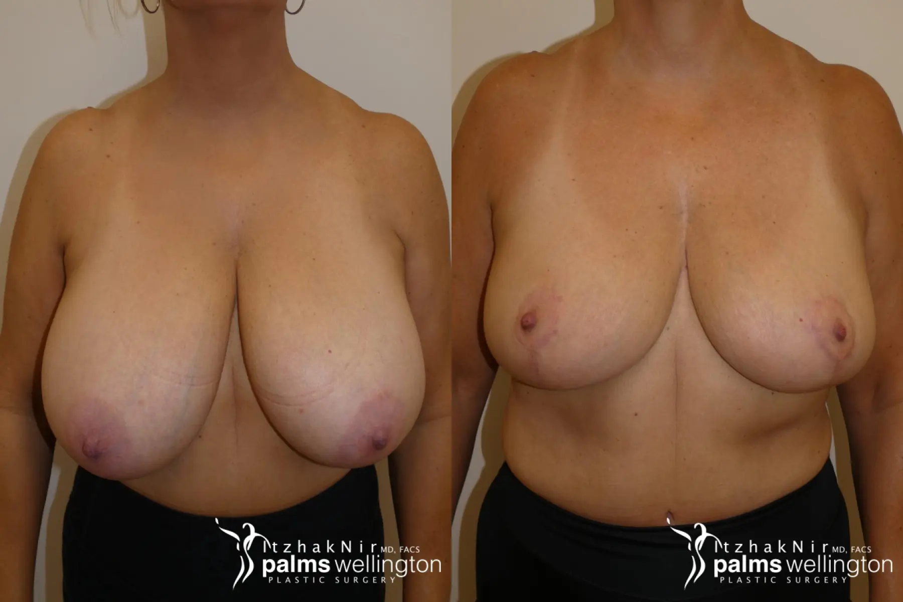Breast Lift | Boca Raton - Before and After