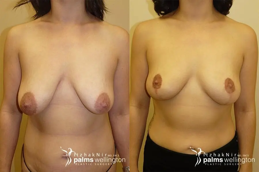Breast Lift: Case 993 - Before and After