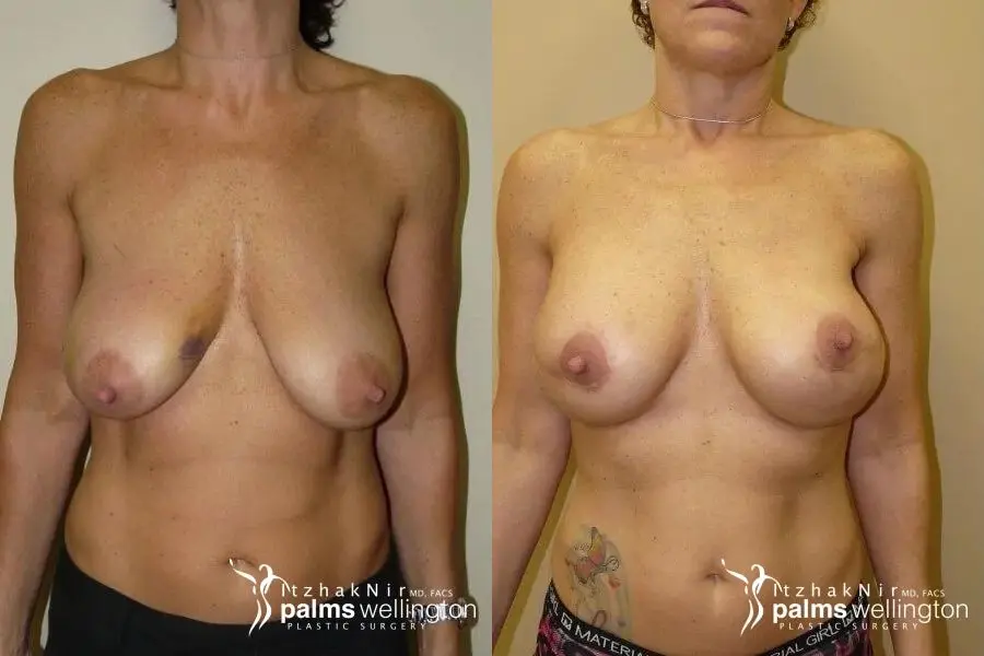 Breast Reconstruction WestPalmBeach - Before and After