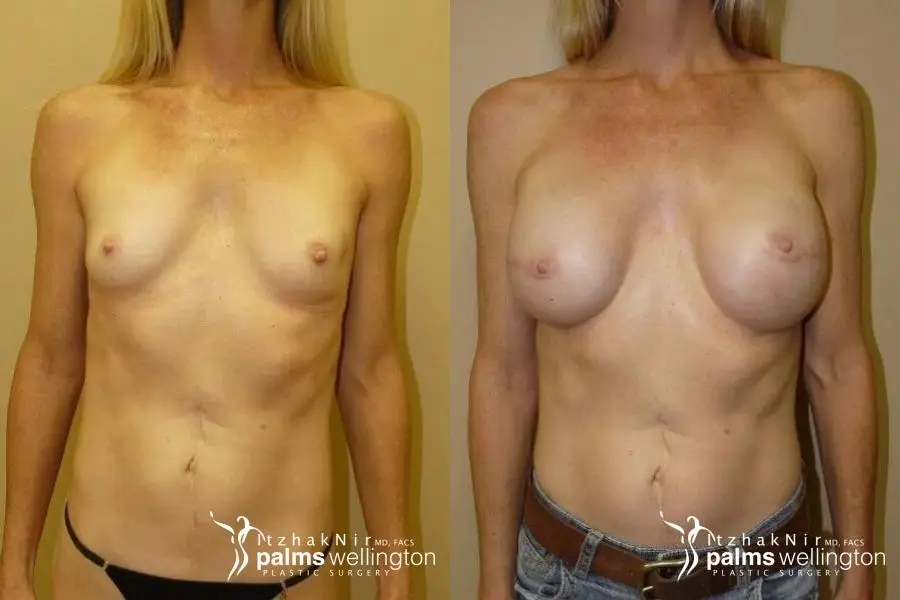 Breast Reconstruction: Case 1 - Before and After  
