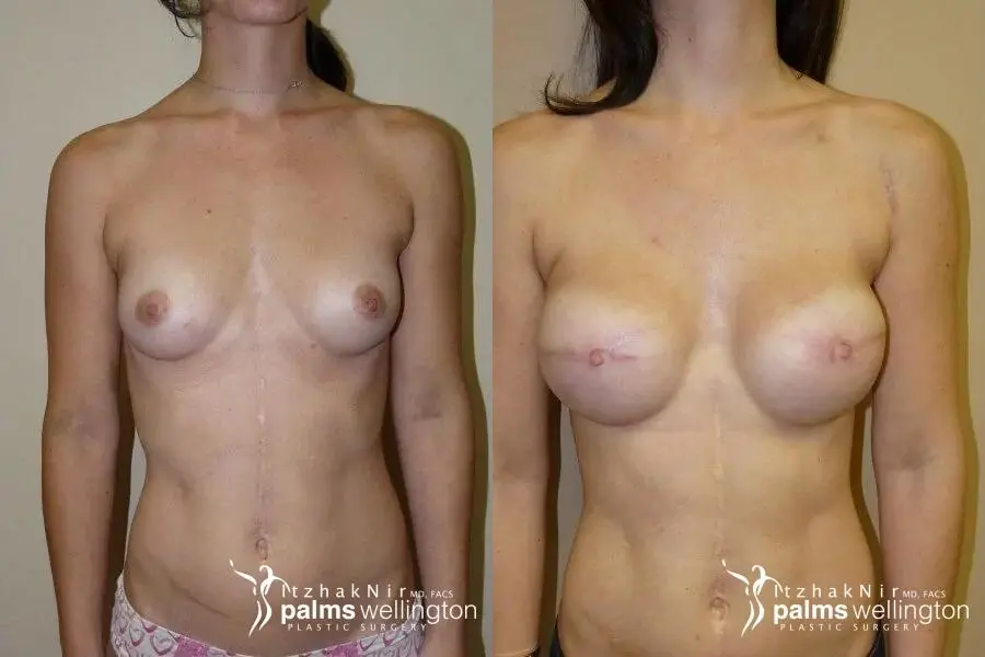 Breast Reconstruction WestPalmBeach - Before and After