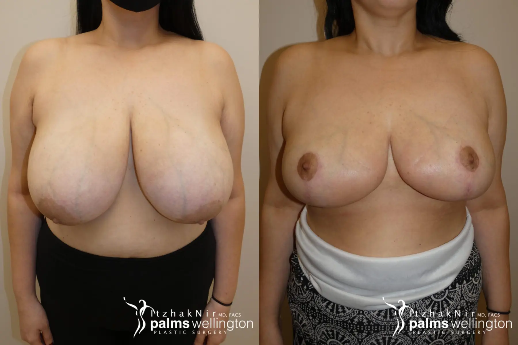 Breast Reduction WestPalmBeach - Before and After