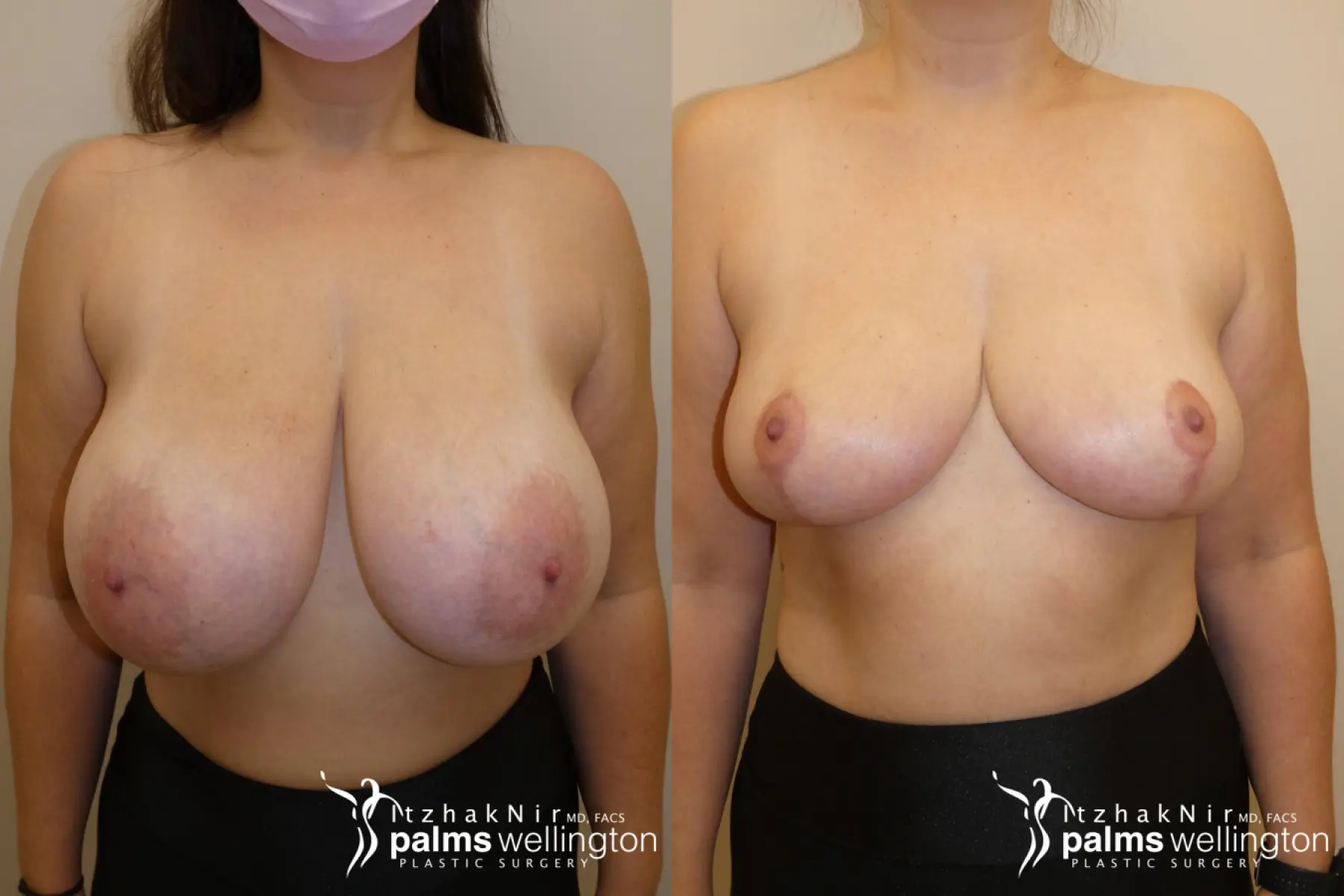 Breast Reduction WestPalmBeach - Before and After