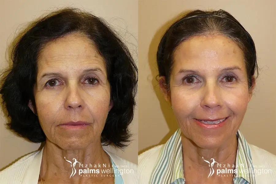 brow lift west palm beach front and side - Before and After