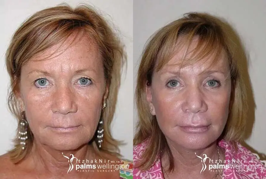 Facelift | Greenacres - Before and After